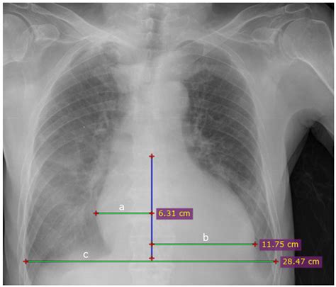 Average Cardiothoracic PA Salary: A Deep Dive