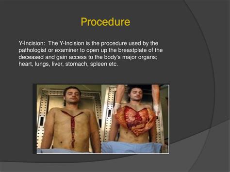 What Does an Autopsy Pathologist Do?
